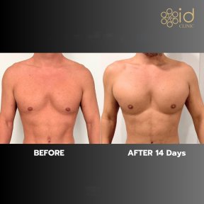 Before and after pectoral implants at ID Clinic Bangkok, enhanced chest contour results