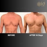 Before and after pectoral implants at ID Clinic Bangkok, enhanced chest contour results