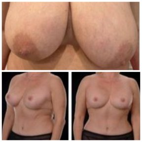 Before and after breast reduction results at Yurchenko Plastic Surgery Team, improved contour