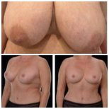 Before and after breast reduction results at Yurchenko Plastic Surgery Team, improved contour