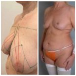 Before and after breast reduction results at Yurchenko Plastic Surgery Team, improved contour