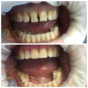Efekty przed i po założeniu koron w Casa Dental, s.r.o. dla odbudowy uśmiechu