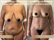 Before and after breast lift, tummy tuck, lipo, and fat transfer at Dr. Safa Manav Clinic results