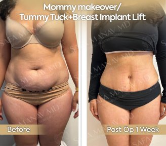 Before and after mommy makeover results at Dr. Safa Manav Clinic, tummy tuck and breast lift