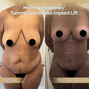Mommy makeover before and after results at Dr. Safa Manav Clinic, tummy tuck and breast lift