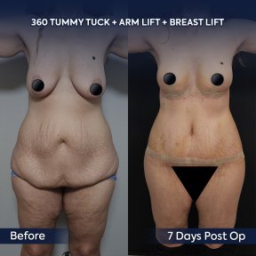Before and after 360 tummy tuck, arm lift, breast lift results at Dr. Safa Manav Clinic