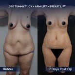Before and after 360 tummy tuck, arm lift, breast lift results at Dr. Safa Manav Clinic