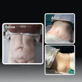 Before and after tummy tuck results at Assoc.Prof.Dr.Cemal Kara / Medical Park İzmir Hospital