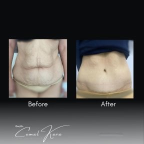 Tummy tuck before and after results at Assoc.Prof.Dr.Cemal Kara / Medical Park İzmir Hospital