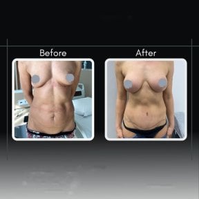 Before and after tummy tuck results at Assoc.Prof.Dr.Cemal Kara / Medical Park İzmir Hospital