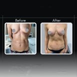 Before and after tummy tuck results at Assoc.Prof.Dr.Cemal Kara / Medical Park İzmir Hospital