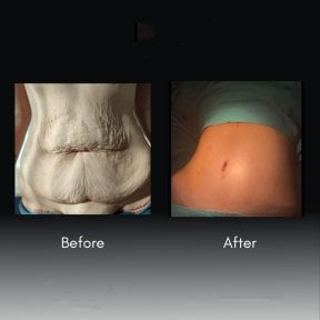 Before and after tummy tuck results at Assoc.Prof.Dr.Cemal Kara / Medical Park İzmir Hospital