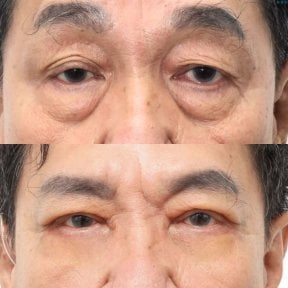 Before and after upper and lower eyelid surgery results at Wansiri Hospital, rejuvenated eyes