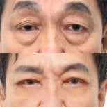 Before and after upper and lower eyelid surgery results at Wansiri Hospital, rejuvenated eyes