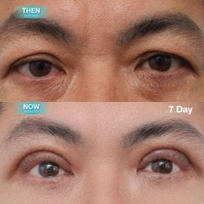 Before and after upper and lower eyelid surgery results at Wansiri Hospital, 7 days post-op