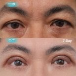 Before and after upper and lower eyelid surgery results at Wansiri Hospital, 7 days post-op