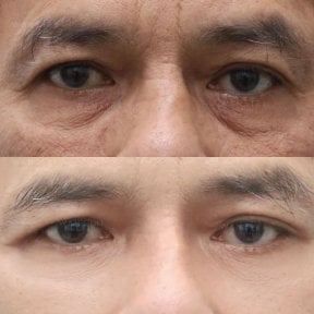 Before and after upper and lower eyelid surgery results at Wansiri Hospital, rejuvenated eyes