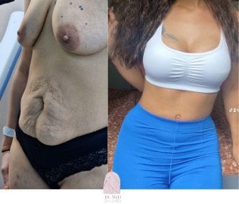 Before and after breast lift and tummy tuck results at Dr. MED, visible body contour improvement