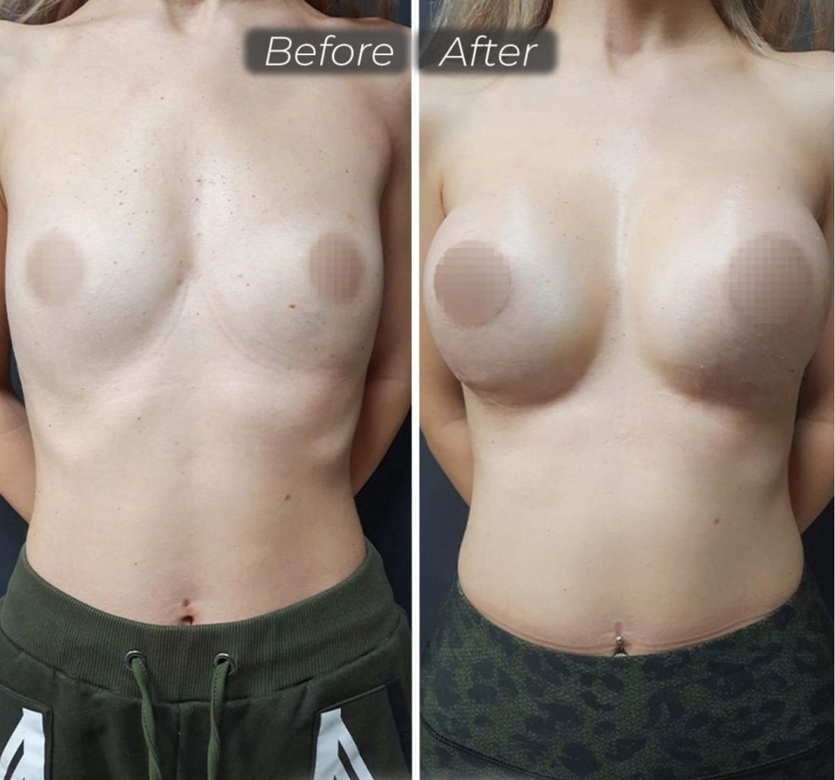 نتائج تكبير الثدي قبل وبعد في عيادة د. صفا مناف، تحسين شكل الثدي