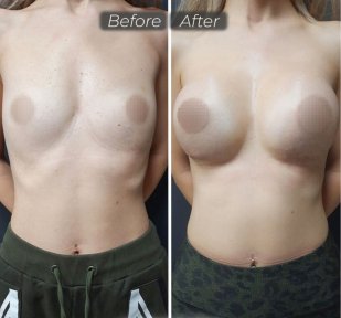 Vorher-nachher-Ergebnis Brustvergrößerung bei Dr. Safa Manav Clinic, verbesserte Form