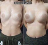 Vorher-nachher-Ergebnis Brustvergrößerung bei Dr. Safa Manav Clinic, verbesserte Form