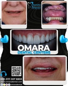 All-on-4 dental implants before and after results at Omara Dental Centers, smile restoration