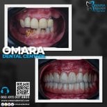Before and after All-on-6 dental implants result at Omara Dental Centers, full smile restoration