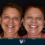 Fotos de antes y después de Implante dental tomadas por el Dr.(la Dra.) 