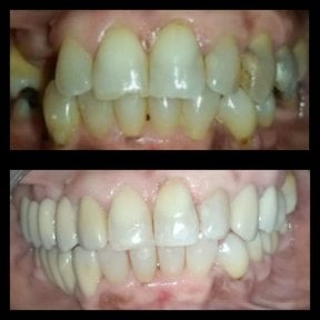 نتائج قبل وبعد جراحة اللثة في عيادة الدكتورة زويلا فرنانديز، تحسن اللثة