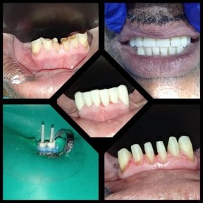 نتائج قبل وبعد جراحة اللثة في عيادة Dra Zoila Fernández، ابتسامة محسنة