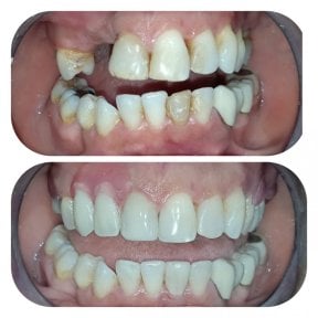 نتائج قبل وبعد جراحة اللثة في عيادة د. زويلا فرنانديز، تحسن اللثة