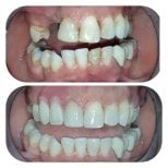 نتائج قبل وبعد جراحة اللثة في عيادة د. زويلا فرنانديز، تحسن اللثة