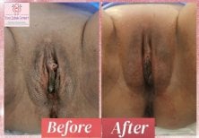 نتائج قبل وبعد تجديد المهبل بالليزر في عيادة د. إسراء جابوك جومرت