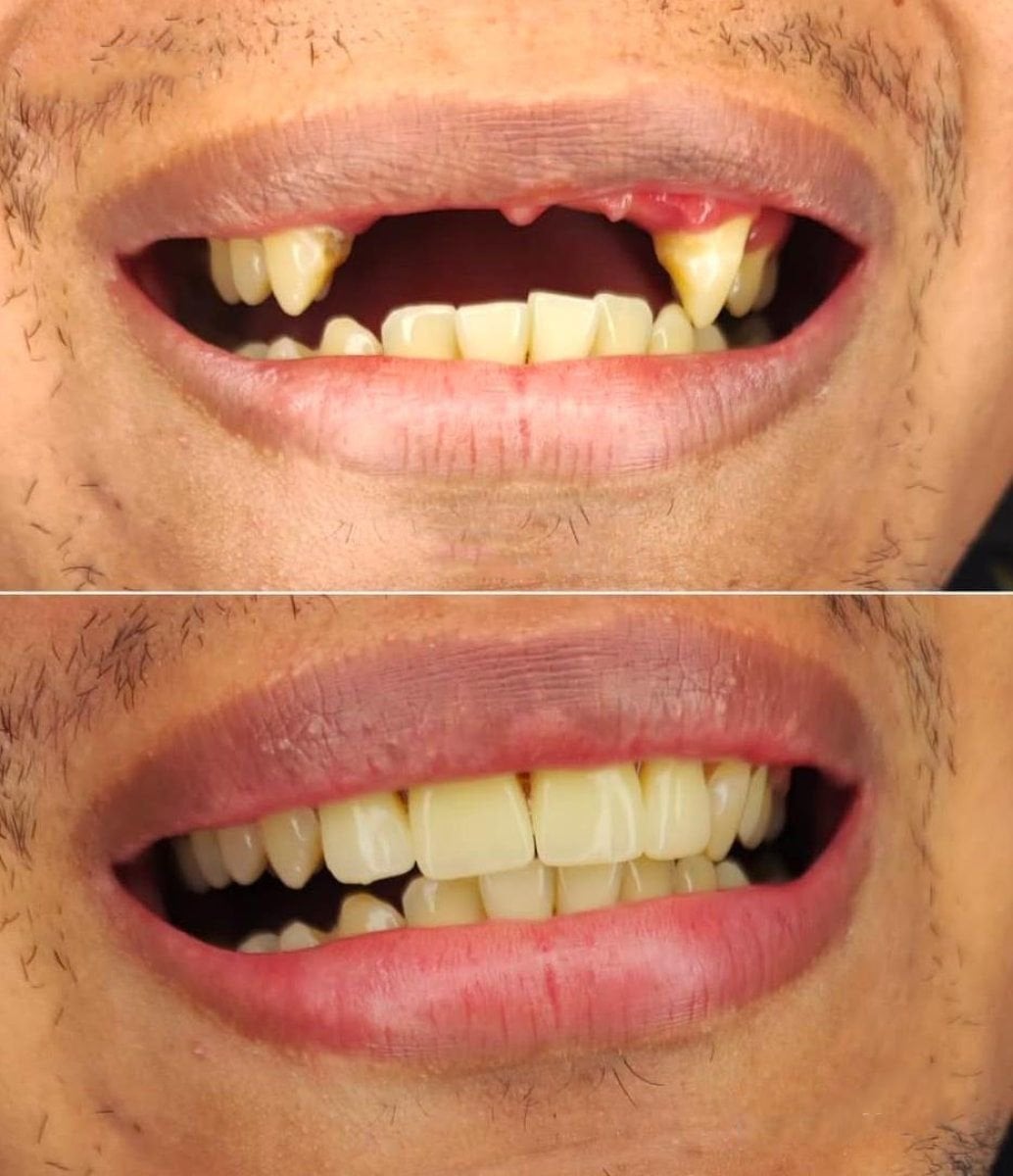 نتيجة قبل وبعد زراعة الأسنان All-on-6 في Love Dental and Sthetic Clinic، ابتسامة مستعادة