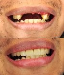 Fotos de antes y después de Implante dental tomadas por el Dr.(la Dra.) 