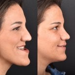 Résultats avant et après remodelage de la mâchoire à Dentavie Istanbul Dental Clinic, profil amélioré