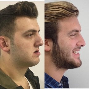 Résultats avant/après remodelage de la mâchoire chez Dentavie Istanbul Dental Clinic, contour amélioré