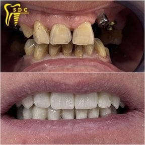 Resultados de antes y después de implantes dentales en Spanderashvili Dental Clinic, restauración de sonrisa