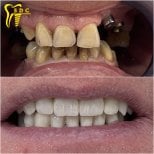 Resultados de antes y después de implantes dentales en Spanderashvili Dental Clinic, restauración de sonrisa