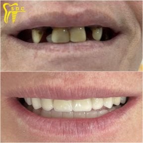 Resultados antes y después de implantes dentales en Spanderashvili Dental Clinic, sonrisa restaurada