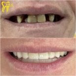 Resultados antes y después de implantes dentales en Spanderashvili Dental Clinic, sonrisa restaurada