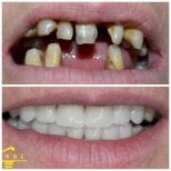 Resultados antes y después de implantes dentales en Spanderashvili Dental Clinic, sonrisa restaurada