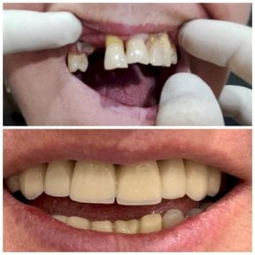 Resultados antes y después de implantes dentales en Spanderashvili Dental Clinic, sonrisa restaurada