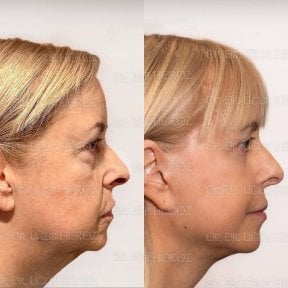 نتائج شد الحاجب قبل وبعد في Dr. MED – تجديد منطقة الجبهة والعينين