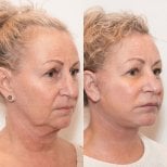 نتائج شد الحاجب قبل وبعد في Dr. MED – تجديد الجبهة والحواجب بشكل ملحوظ