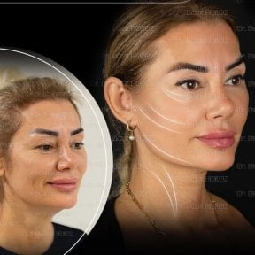 نتائج شد الحاجب قبل وبعد في Dr. MED – تحسين واضح في رفع الحاجب والجبهة