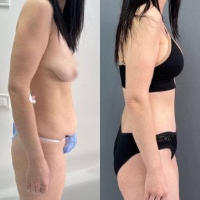 Resultados antes y después de abdominoplastia y liposucción en Dmytrii Homola Clinic, abdomen plano