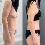 Resultados antes y después de abdominoplastia y liposucción en Dmytrii Homola Clinic, abdomen plano