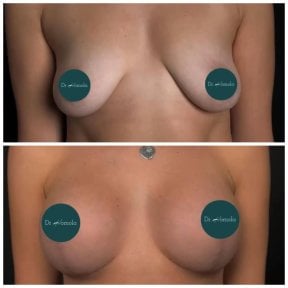 Before and after breast lift results at Dmytrii Homola Clinic, improved breast contour