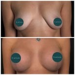 Before and after breast lift results at Dmytrii Homola Clinic, improved breast contour